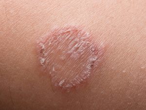 fungal infection on the skin