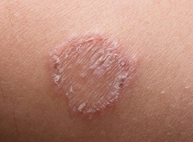 fungal infection on the skin